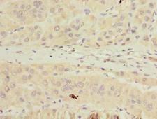TMPRSS6 Antibody - Immunohistochemistry of paraffin-embedded human liver cancer using antibody at dilution of 1:100.