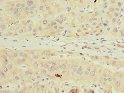 TMPRSS6 Antibody - Immunohistochemistry of paraffin-embedded human liver cancer using TMPRSS6 Antibody at dilution of 1:100