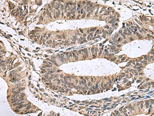 TMX3 Antibody - Immunohistochemistry of paraffin-embedded Human colorectal cancer tissue  using TMX3 Polyclonal Antibody at dilution of 1:70(×200)