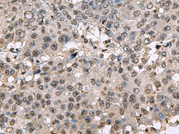 TMX3 Antibody - Immunohistochemistry of paraffin-embedded Human liver cancer tissue  using TMX3 Polyclonal Antibody at dilution of 1:70(×200)