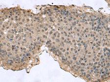 TMX3 Antibody - Immunohistochemistry of paraffin-embedded Human liver cancer tissue  using TMX3 Polyclonal Antibody at dilution of 1:60(×200)