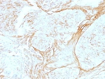 TNC / Tenascin C Antibody - Formalin-fixed, paraffin-embedded human lung carcinoma stained with anti-Tenascin C antibody (SPM319) at 4ug/ml. Antigen retrieval in 10mM Tris with 1mM EDTA, pH 9.0; ABC detection system with DAB Chromagen. Note staining of connective tissue.  This image was taken for the unmodified form of this product. Other forms have not been tested.