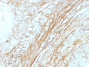 TNC / Tenascin C Antibody - Formalin-fixed, paraffin-embedded human lung carcinoma stained with Tenascin C antibody (T2H5) at 4ug/ml. Antigen retrieval in 10mM Tris with 1mM EDTA, pH 9.0; ABC detection system with DAB Chromagen. Note staining of connective tissue.  This image was taken for the unmodified form of this product. Other forms have not been tested.