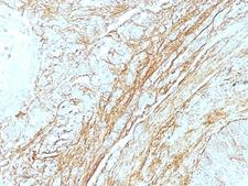 TNC / Tenascin C Antibody - Formalin-fixed, paraffin-embedded human lung carcinoma stained with Tenascin C antibody (T2H5) at 4ug/ml. Antigen retrieval in 10mM Tris with 1mM EDTA, pH 9.0; ABC detection system with DAB Chromagen. Note staining of connective tissue.  This image was taken for the unmodified form of this product. Other forms have not been tested.