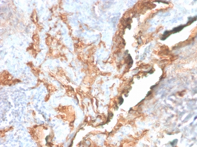 TNC / Tenascin C Antibody - Formalin-fixed, paraffin-embedded human Lung Carcinoma stained with Tenascin C Rabbit Recombinant Monoclonal Antibody (TNC/2981R).