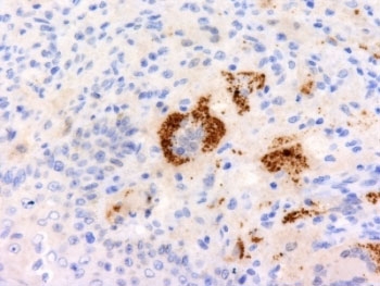 TNF Alpha Antibody - Formalin-fixed, paraffin-embedded human Erdheim Chester disease (also known as polyostotic sclerosing histiocytosis) stained with TNF-a antibody (P/T2).  This image was taken for the unmodified form of this product. Other forms have not been tested.