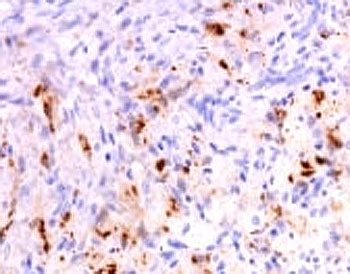TNF Alpha Antibody - Formalin-fixed, paraffin-embedded human polyostotic sclerosing histiocytosis (Erdheim Chester disease) stained with anti-TNF alpha antibody (SPM543).  This image was taken for the unmodified form of this product. Other forms have not been tested.