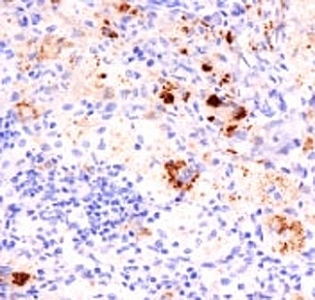 TNF Alpha Antibody - Formalin-fixed, paraffin-embedded human Erdheim Chester disease (also known as polyostotic sclerosing histiocytosis) stained with TNF alpha antibody (TNF706 + P/T2).  This image was taken for the unmodified form of this product. Other forms have not been tested.