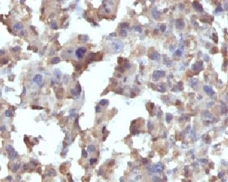 TNF Alpha Antibody - Formalin-fixed, paraffin-embedded human Histiocytoma stained with TNF alpha antibody (TNFA/1172).  This image was taken for the unmodified form of this product. Other forms have not been tested.