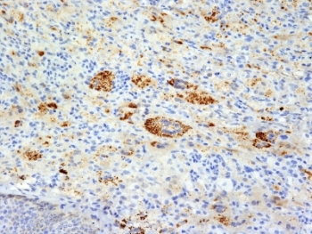 TNF Alpha Antibody - Formalin-fixed, paraffin-embedded human Erdheim Chester disease (also known as polyostotic sclerosing histiocytosis) stained with TNF alpha antibody (TNFA/1172).  This image was taken for the unmodified form of this product. Other forms have not been tested.