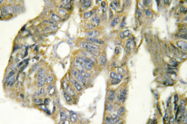 TNF Alpha Antibody - IHC of TNF (Q178) pAb in paraffin-embedded human colon carcinoma tissue.