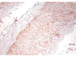 TNF Alpha Antibody - Anti-Human TNFa Antibody - Immunohistochemistry. Immunohistochemistry using polyclonal TNFa antibody showing staining of formalin/PFA-fixed paraffin-embedded sections of human artery tissue sections. Sections were fixed in formaldehyde and subjected to heat mediated antigen retrieval in citrate buffer (pH 6.0). Slides were blocked for ten minutes with 1.5% serum. Primary antibody was diluted 1:100 and incubated with samples for 24 hours at 4°C. HRP-conjugated goat anti-rabbit antibody was used as the secondary antibody.