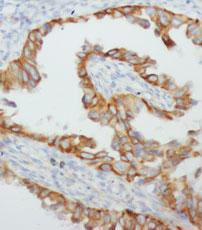 TNF Alpha Antibody - TNF-alpha staining in human mammary cancer. Paraffin-embedded human mammary cancer is stained with TNF-alpha used at 1:200 dilution.