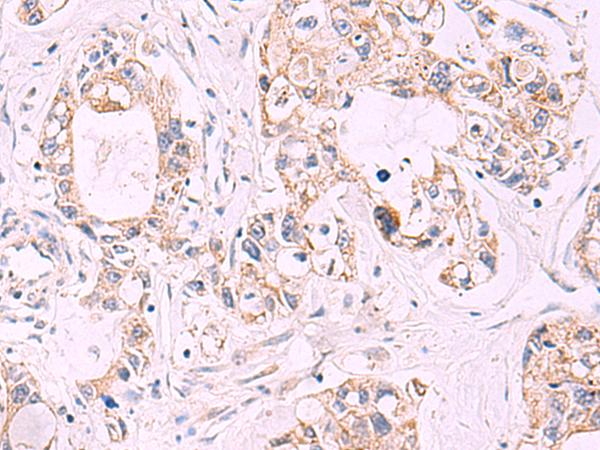 TNF Alpha Antibody - Immunohistochemistry of paraffin-embedded Human gastric cancer tissue  using TNF Polyclonal Antibody at dilution of 1:40(×200)