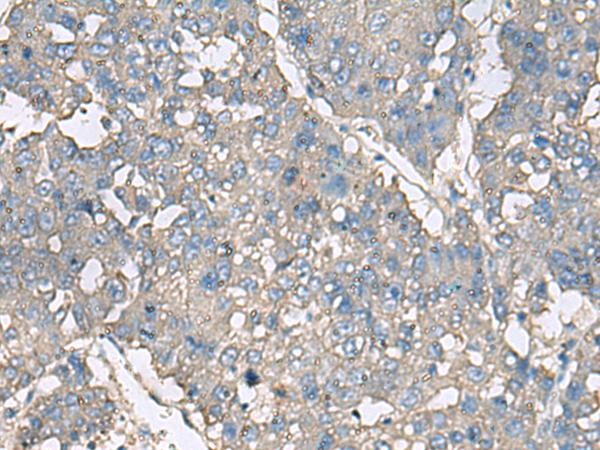 TNF Alpha Antibody - Immunohistochemistry of paraffin-embedded Human liver cancer tissue  using TNF Polyclonal Antibody at dilution of 1:40(×200)