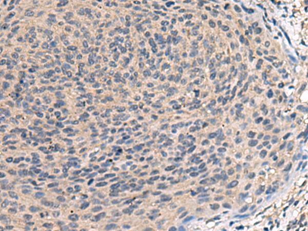 TNF Alpha Antibody - Immunohistochemistry of paraffin-embedded Human cervical cancer tissue  using TNF Polyclonal Antibody at dilution of 1:40(×200)