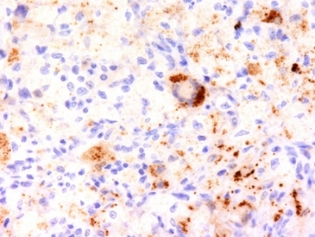 TNF Alpha Antibody - Formalin-fixed, paraffin-embedded human Erdheim Chester disease (also known as polyostotic sclerosing histiocytosis) stained with TNFa antibody (TNF706).  This image was taken for the unmodified form of this product. Other forms have not been tested.