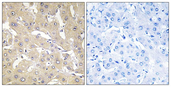 TNFAIP2 Antibody - Immunohistochemistry analysis of paraffin-embedded human liver carcinoma tissue, using TNAP2 Antibody. The picture on the right is blocked with the synthesized peptide.