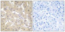 TNFAIP2 Antibody - Peptide - + Immunohistochemistry analysis of paraffin-embedded human liver carcinoma tissue, using TNAP2 antibody.