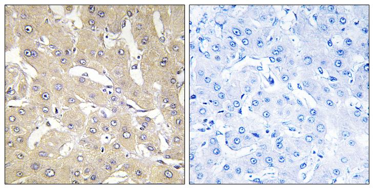 TNFAIP2 Antibody - Peptide - + Immunohistochemistry analysis of paraffin-embedded human liver carcinoma tissue, using TNAP2 antibody.