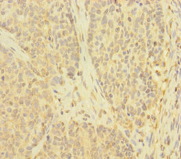 TNFAIP6 / TSG-6 Antibody - Immunohistochemistry of paraffin-embedded human ovarian cancer using TNFAIP6 Antibody at dilution of 1:100