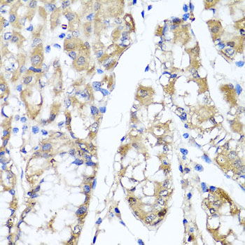TNFAIP6 / TSG-6 Antibody - Immunohistochemistry of paraffin-embedded human gastric using TNFAIP6 antibody at dilution of 1:100 (x40 lens).