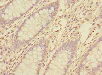 TNFAIP8 / SCC-S2 Antibody - Immunohistochemistry of paraffin-embedded human colon cancer at dilution 1:100