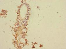 TNFAIP8 / SCC-S2 Antibody - Immunohistochemistry of paraffin-embedded human breast cancer at dilution 1:100
