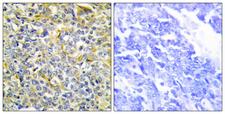 TNFAIP8 / SCC-S2 Antibody - Peptide - + Immunohistochemistry analysis of paraffin-embedded human lung carcinoma tissue using TFIP8 antibody.