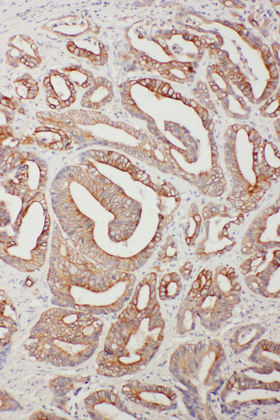 TNFAIP8L3 Antibody - TNFAIP8L3 antibody. IHC(P): Human Intestinal Cancer Tissue.
