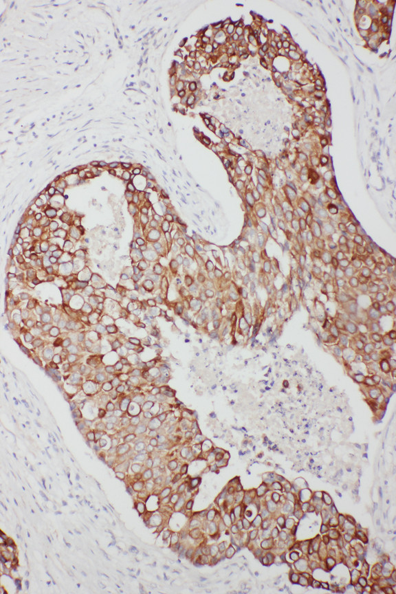 TNFAIP8L3 Antibody - TNFAIP8L3 antibody. IHC(P): Human Breast Cancer Tissue.