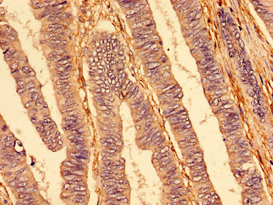 TNFRSF10A / DR4 Antibody - IHC image of TNFRSF10A Antibody diluted at 1:400 and staining in paraffin-embedded human colon cancer performed on a Leica BondTM system. After dewaxing and hydration, antigen retrieval was mediated by high pressure in a citrate buffer (pH 6.0). Section was blocked with 10% normal goat serum 30min at RT. Then primary antibody (1% BSA) was incubated at 4°C overnight. The primary is detected by a biotinylated secondary antibody and visualized using an HRP conjugated SP system.