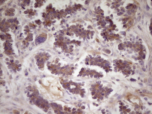 TNFRSF10B / Killer / DR5 Antibody - Immunohistochemical staining of paraffin-embedded Adenocarcinoma of Human ovary tissue using anti-TNFRSF10B mouse monoclonal antibody. (Heat-induced epitope retrieval by 1 mM EDTA in 10mM Tris, pH8.5, 120C for 3min,