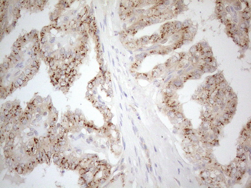 TNFRSF10B / Killer / DR5 Antibody - Immunohistochemical staining of paraffin-embedded Carcinoma of Human thyroid tissue using anti-TNFRSF10B mouse monoclonal antibody. (Heat-induced epitope retrieval by 1mM EDTA in 10mM Tris buffer. (pH8.5) at 120°C for 3 min. (1:150)