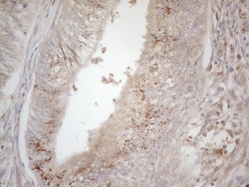 TNFRSF10B / Killer / DR5 Antibody - Immunohistochemical staining of paraffin-embedded Adenocarcinoma of Human colon tissue using anti-TNFRSF10B mouse monoclonal antibody. (Heat-induced epitope retrieval by 1mM EDTA in 10mM Tris buffer. (pH8.5) at 120°C for 3 min. (1:150)
