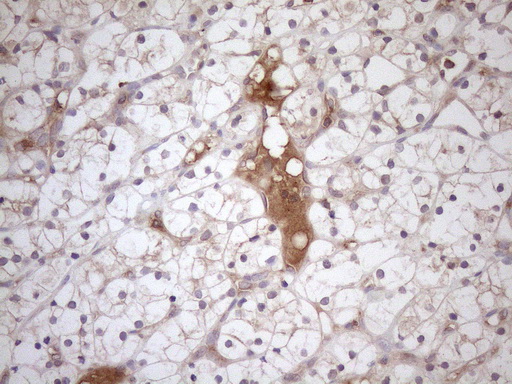 TNFRSF10B / Killer / DR5 Antibody - Immunohistochemical staining of paraffin-embedded Carcinoma of Human kidney tissue using anti-TNFRSF10B mouse monoclonal antibody at 1:150. (Heat-induced epitope retrieval by 1mM EDTA in 10mM Tris buffer. (pH8.5) at 120°C for 3 min. (1:150)