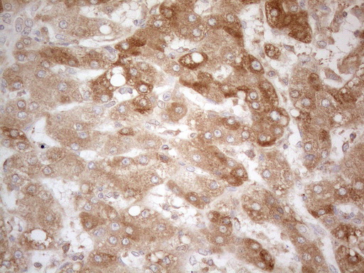 TNFRSF10B / Killer / DR5 Antibody - Immunohistochemical staining of paraffin-embedded Carcinoma of Human liver tissue using anti-TNFRSF10B mouse monoclonal antibody. (Heat-induced epitope retrieval by 1mM EDTA in 10mM Tris buffer. (pH8.5) at 120°C for 3 min. (1:150)