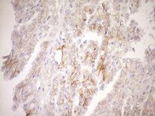 TNFRSF10B / Killer / DR5 Antibody - Immunohistochemical staining of paraffin-embedded Carcinoma of Human thyroid tissue using anti-TNFRSF10B mouse monoclonal antibody. (Heat-induced epitope retrieval by 1mM EDTA in 10mM Tris buffer. (pH8.5) at 120°C for 3 min. (1:150)