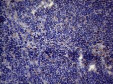 TNFRSF10B / Killer / DR5 Antibody - Immunohistochemical staining of paraffin-embedded Carcinoma of Human lung tissue using anti-TNFRSF10B mouse monoclonal antibody. (Heat-induced epitope retrieval by 1mM EDTA in 10mM Tris buffer. (pH8.5) at 120°C for 3 min. (1:150)