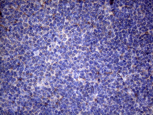 TNFRSF10B / Killer / DR5 Antibody - Immunohistochemical staining of paraffin-embedded Human lymphoma tissue using anti-TNFRSF10B mouse monoclonal antibody. (Heat-induced epitope retrieval by 1mM EDTA in 10mM Tris buffer. (pH8.5) at 120°C for 3 min. (1:150)