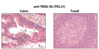 TNFRSF10B / Killer / DR5 Antibody - Immunohistochemistry detection of endogenous TRAIL-R2 in paraffin-embedded human carcinoma tissues (colon, tonsil) using mAb to TRAIL-R2 (TR2.21) .