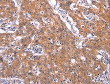 TNFRSF17 / BCMA Antibody - Immunohistochemistry of paraffin-embedded Human gastric cancer using TNFRSF17 Polyclonal Antibody at dilution of 1:30.