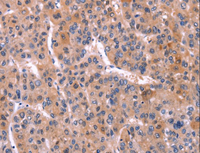 TNFRSF17 / BCMA Antibody - Immunohistochemistry of paraffin-embedded Human liver cancer using TNFRSF17 Polyclonal Antibody at dilution of 1:30.