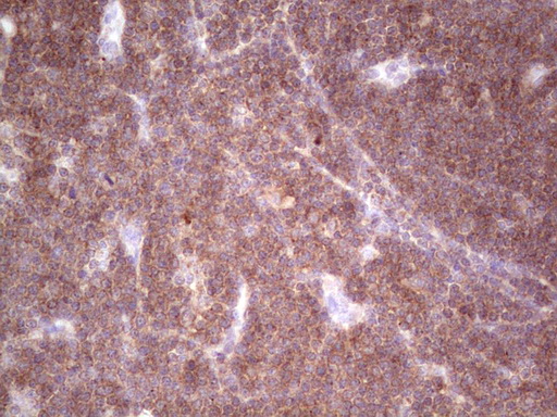 TNFRSF18 / GITR Antibody - Immunohistochemical staining of paraffin-embedded Human lymphoma tissue using anti-TNFRSF18 mouse monoclonal antibody.  heat-induced epitope retrieval by 1 mM EDTA in 10mM Tris, pH8.5, 120C for 3min)