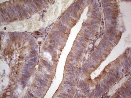 TNFRSF18 / GITR Antibody - Immunohistochemical staining of paraffin-embedded Adenocarcinoma of Human colon tissue using anti-TNFRSF18 mouse monoclonal antibody.  heat-induced epitope retrieval by 1 mM EDTA in 10mM Tris, pH8.5, 120C for 3min)