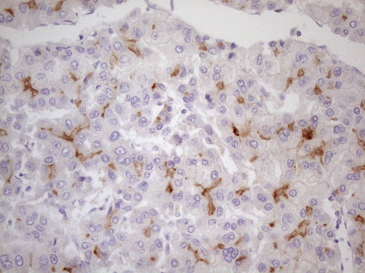TNFRSF18 / GITR Antibody - Immunohistochemical staining of paraffin-embedded Carcinoma of Human liver tissue using anti-TNFRSF18 mouse monoclonal antibody. (Heat-induced epitope retrieval by 1mM EDTA in 10mM Tris buffer. (pH8.0) at 120C for 3 min. (1:200)