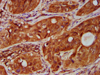 TNFRSF18 / GITR Antibody - Immunohistochemistry Dilution at 1:500 and staining in paraffin-embedded human cervical cancer performed on a Leica BondTM system. After dewaxing and hydration, antigen retrieval was mediated by high pressure in a citrate buffer (pH 6.0). Section was blocked with 10% normal Goat serum 30min at RT. Then primary antibody (1% BSA) was incubated at 4°C overnight. The primary is detected by a biotinylated Secondary antibody and visualized using an HRP conjugated SP system.