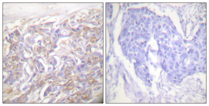 TNFRSF1A / TNFR1 Antibody - Immunohistochemistry analysis of paraffin-embedded human breast carcinoma tissue, using TNF Receptor I Antibody. The picture on the right is blocked with the synthesized peptide.