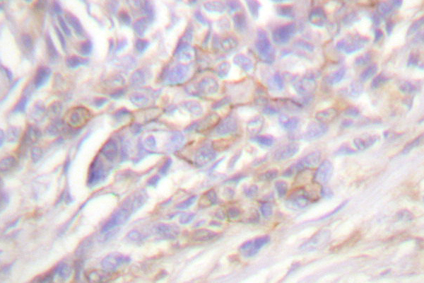 TNFRSF1A / TNFR1 Antibody - IHC of TNF Receptor-1 (A405) pAb in paraffin-embedded human breast carcinoma tissue.