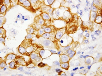 TNFRSF1B / TNFR2 Antibody - IHC-P: TNFR2 antibody testing of human breast cancer tissue